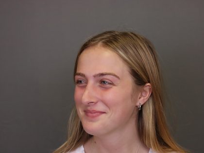 Rhinoplasty Before & After Patient #4437