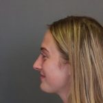 Rhinoplasty Before & After Patient #4437