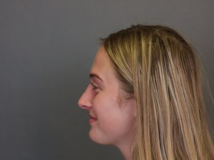 Rhinoplasty Before & After Patient #4437