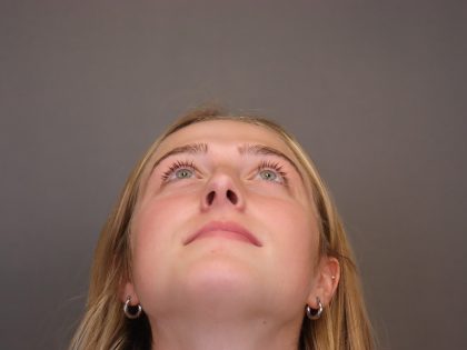 Rhinoplasty Before & After Patient #4437