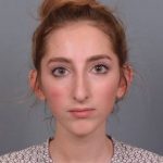 Rhinoplasty Before & After Patient #3629