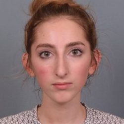 Rhinoplasty Before & After Patient #3629
