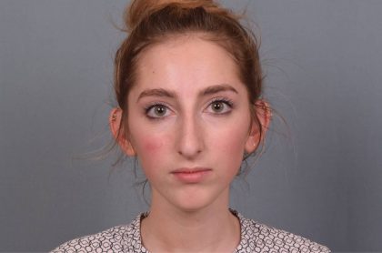 Rhinoplasty Before & After Patient #3629