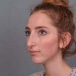 Rhinoplasty Before & After Patient #3629