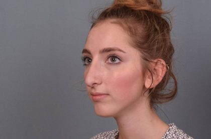Rhinoplasty Before & After Patient #3629