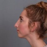Rhinoplasty Before & After Patient #3629