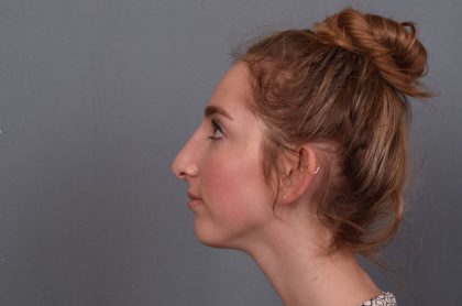 Rhinoplasty Before & After Patient #3629