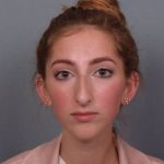 Rhinoplasty Before & After Patient #3629