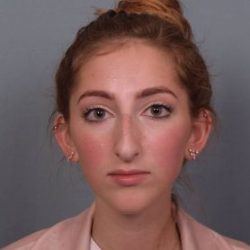 Rhinoplasty Before & After Patient #3629