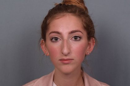 Rhinoplasty Before & After Patient #3629