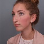 Rhinoplasty Before & After Patient #3629