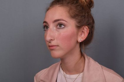 Rhinoplasty Before & After Patient #3629