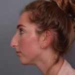 Rhinoplasty Before & After Patient #3629