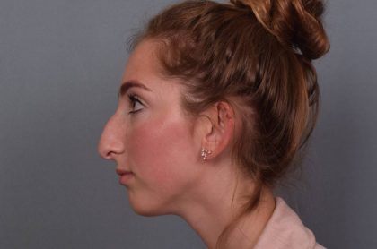 Rhinoplasty Before & After Patient #3629