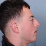 Rhinoplasty Before & After Patient #3623