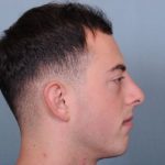 Rhinoplasty Before & After Patient #3623