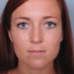 Rhinoplasty Before & After Patient #3618