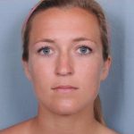 Rhinoplasty Before & After Patient #3618