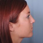 Rhinoplasty Before & After Patient #3618