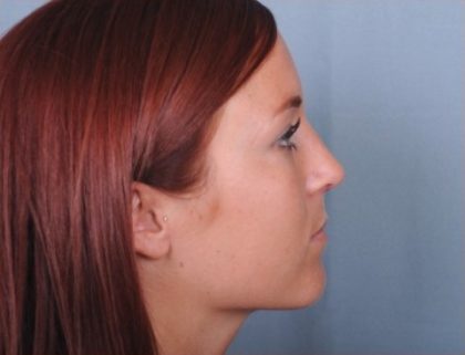 Rhinoplasty Before & After Patient #3618
