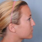 Rhinoplasty Before & After Patient #3618