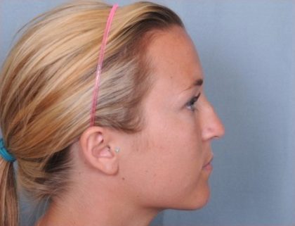 Rhinoplasty Before & After Patient #3618
