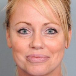 Blepharoplasty Before & After Patient #4540