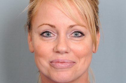 Blepharoplasty Before & After Patient #4540