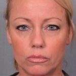 Blepharoplasty Before & After Patient #4540