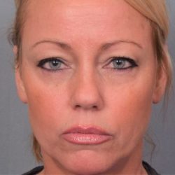 Blepharoplasty Before & After Patient #4540