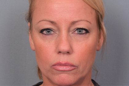 Blepharoplasty Before & After Patient #4540